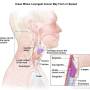 head_neck_vocal_cords-786385-750.jpg